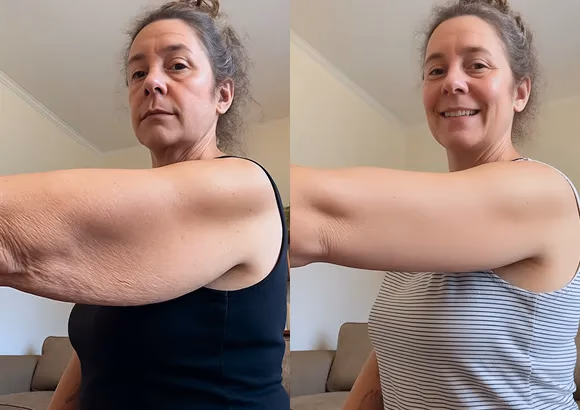 before and after arm toning treatment results comparison