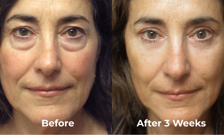 before and after eye lift treatment results on a woman