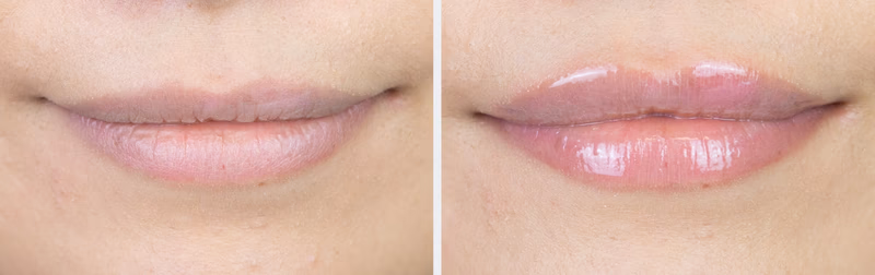 before and after lip plumping comparison