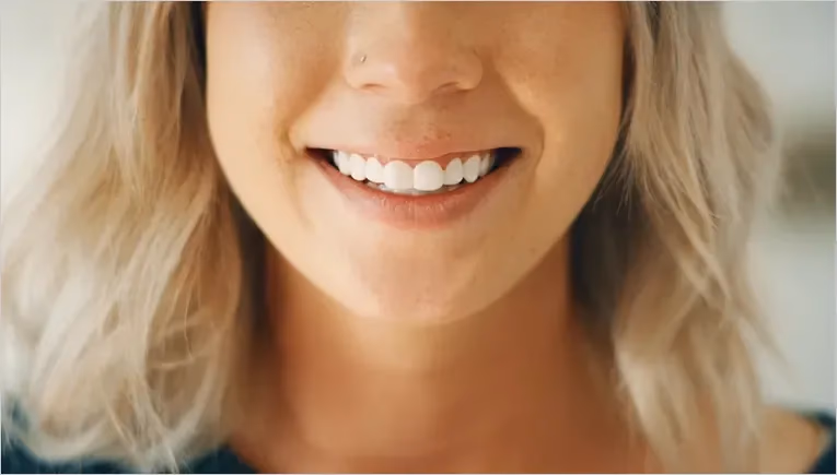 close up of woman smiling with perfect white veneers