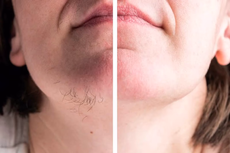 glabrous skin before and after hair removal comparison