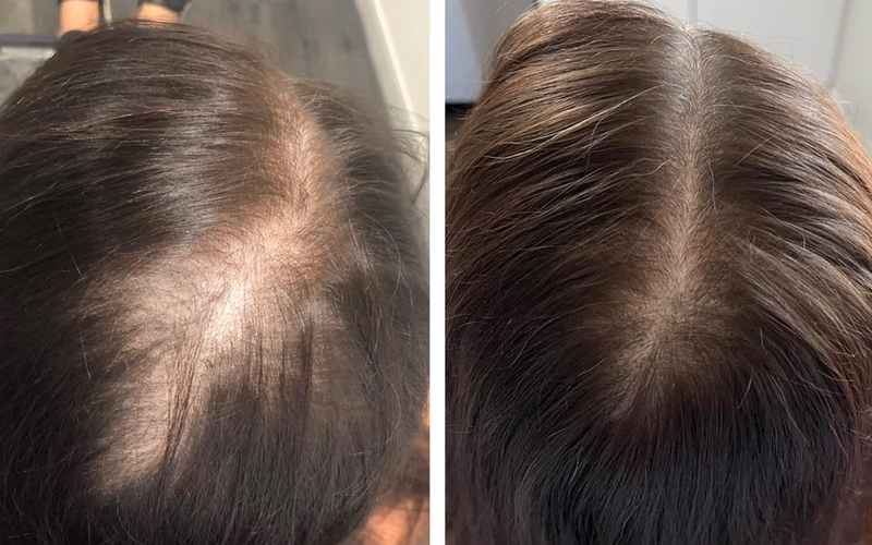 halogrow hair growth spray before and after results