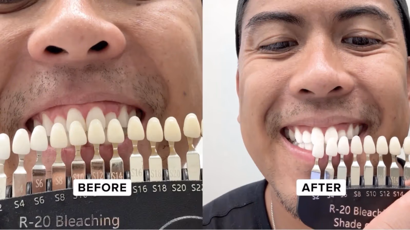 laughland before and after teeth whitening