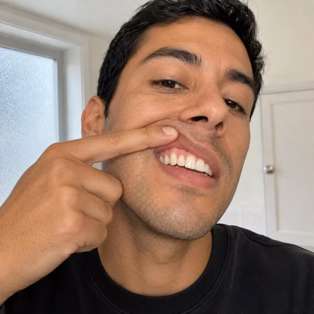 man showing his gums with 360brite gum restore therapy