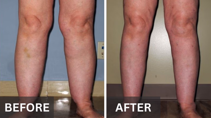 nooro leg massager before and after legs