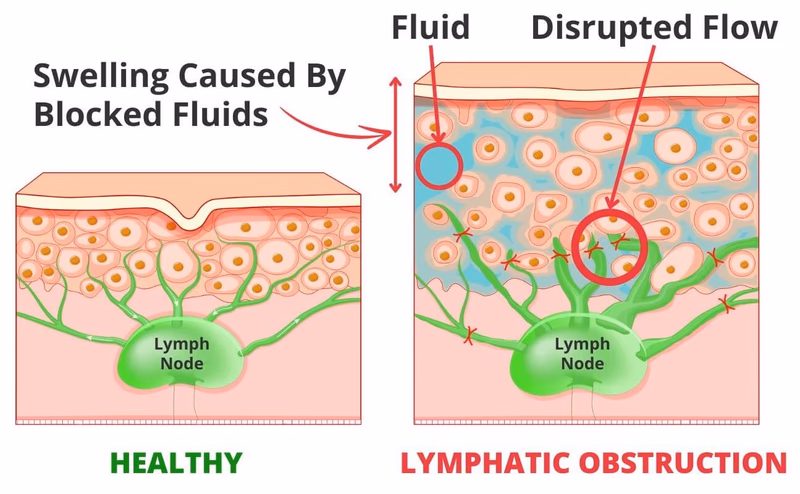 nooro leg massager lymphatic obstruction illustration
