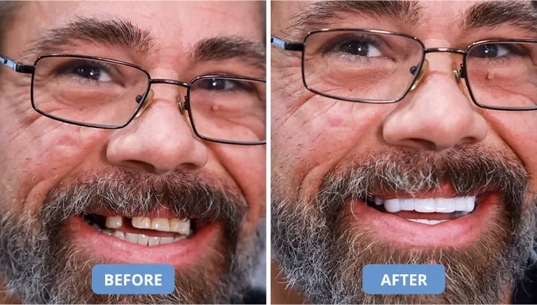 shiny smile veneers before and after comparison