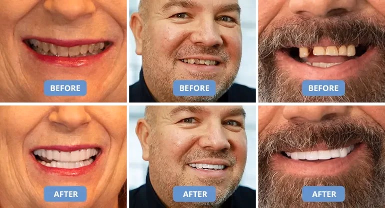 shiny smile veneers before and after comparisons
