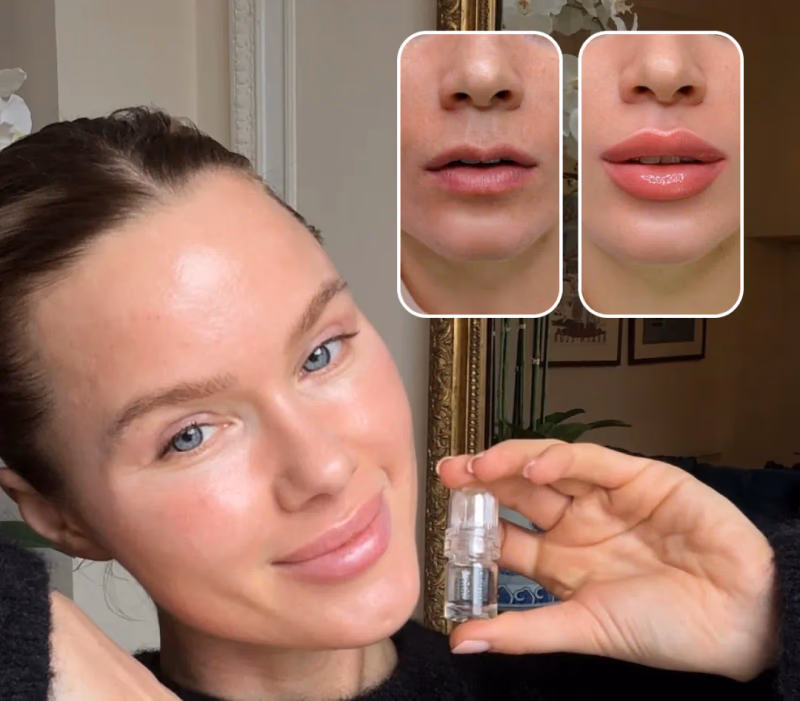 woman holding lip filler vial with before after lip comparis